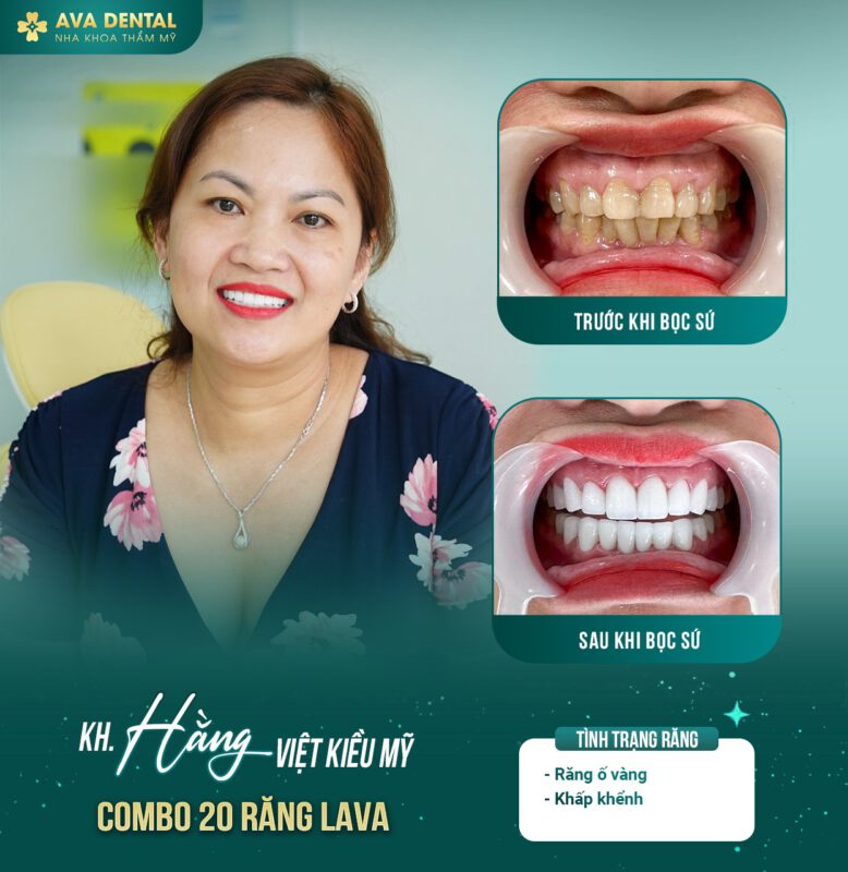 Răng bọc sứ bị viêm tủy: Nguyên nhân và cách khắc phục 4 372063674 678077147684959 6850444621700309310 n 1