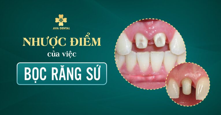 nhược điểm của việc bọc răng sứ
