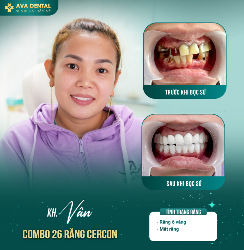 Khám phá các loại răng sứ phổ biến thị trường hiện nay 9 Van 1