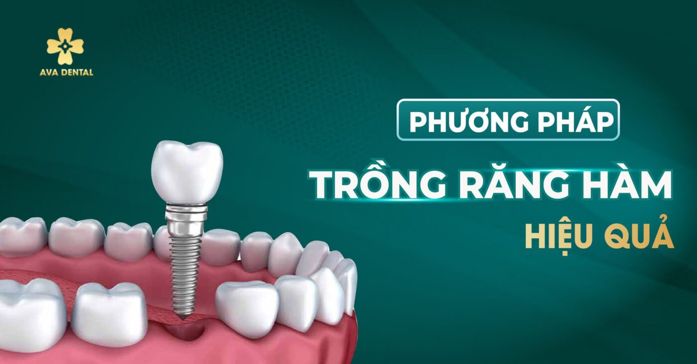 Phương pháp trồng răng hàm hiệu quả 5 phương pháp trồng răng hàm hiệu quả