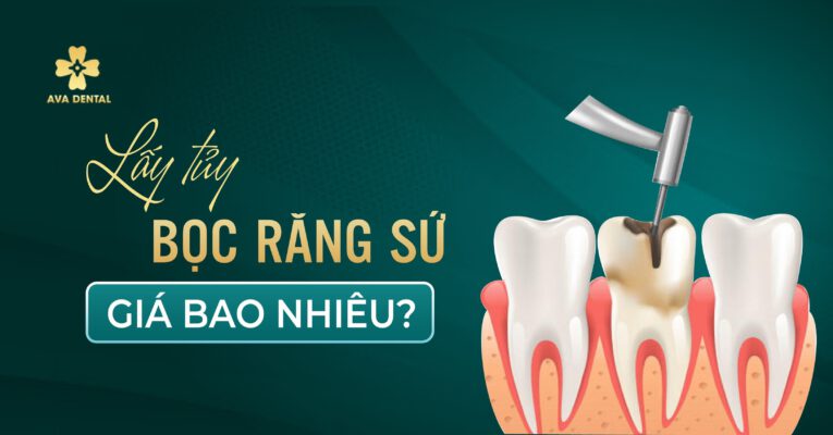 lấy tủy bọc răng sứ giá bao nhiêu