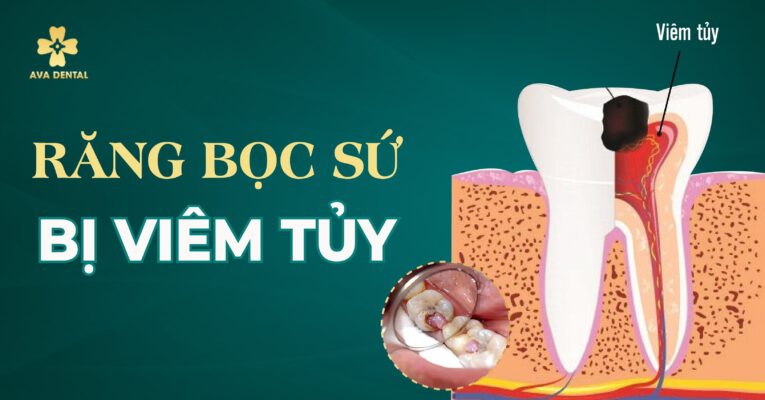 răng bọc sứ bị viêm tủy