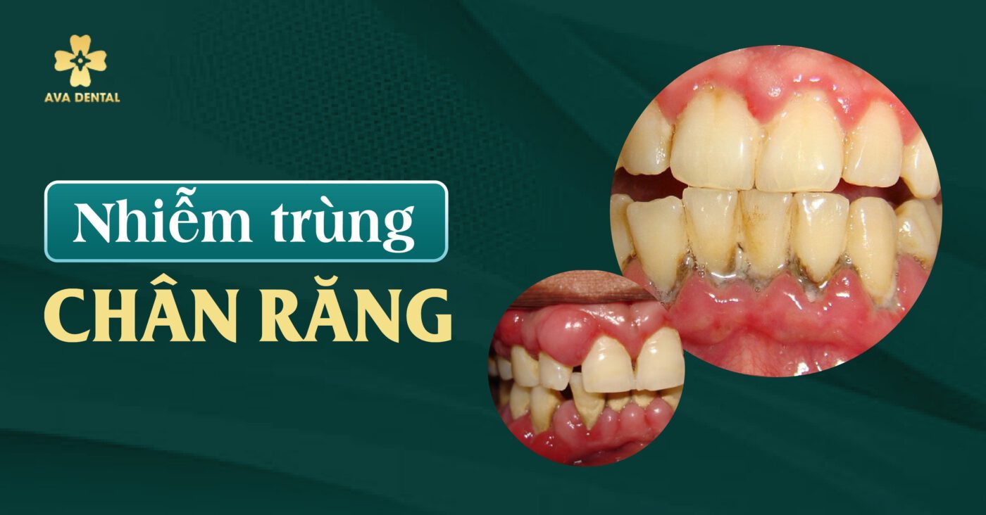Nhiễm trùng chân răng: Nguyên nhân và cách điều trị hiệu quả 4 nhiễm trùng chân răng