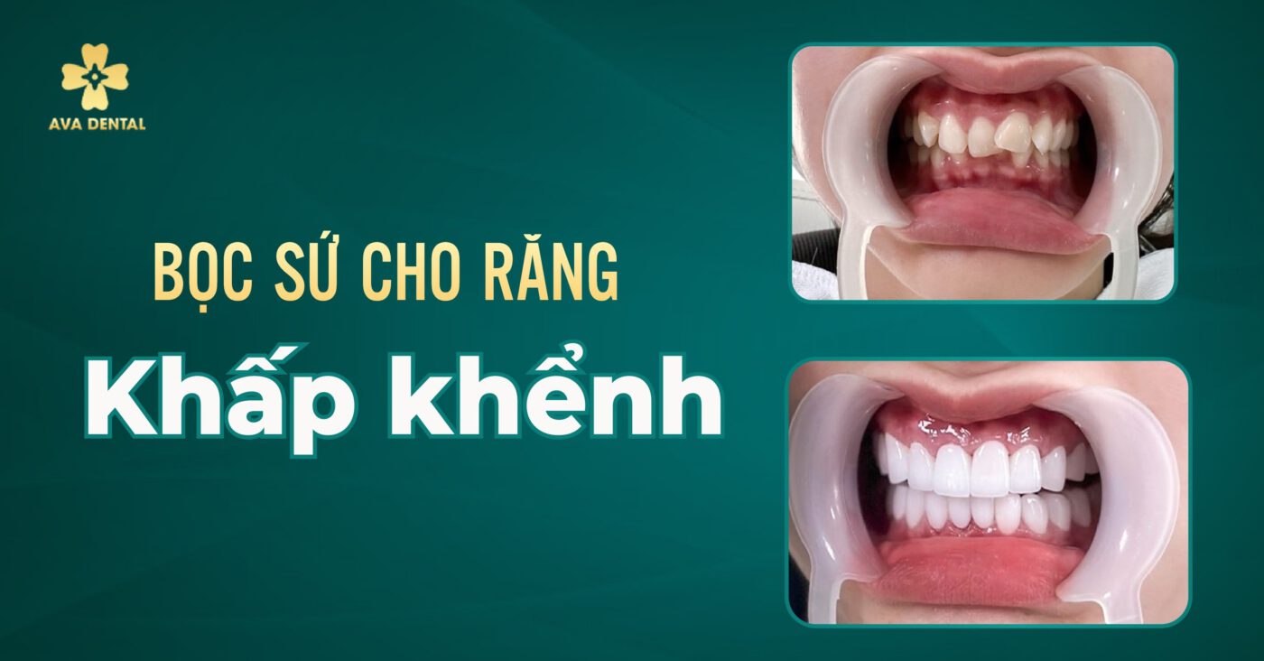 Bọc sứ cho răng khấp khểnh - Hiệu quả ngay, thời gian ngắn 4 z4593531258023 84f33230405f1704f6b4d3a78fc39ab2