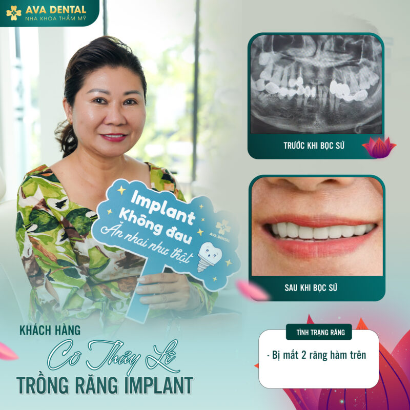 Bật Mí Thông Tin Hữu Ích Về Trồng Răng Implant 11 Trồng răng implant