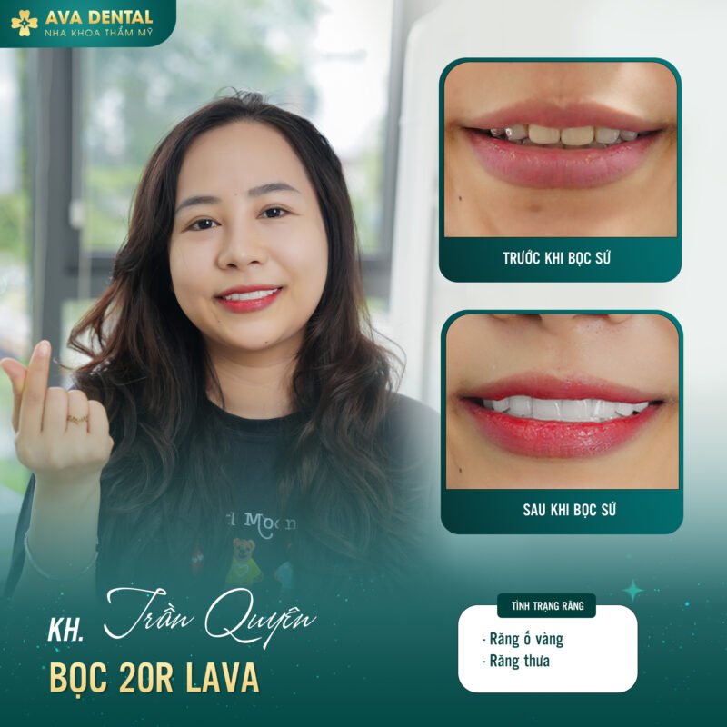 Khám phá các loại răng sứ phổ biến thị trường hiện nay 8 373297780 678779550948052 1319064583271380057 n