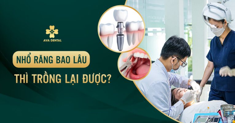 Nhổ răng bao lâu thì trồng lại được?