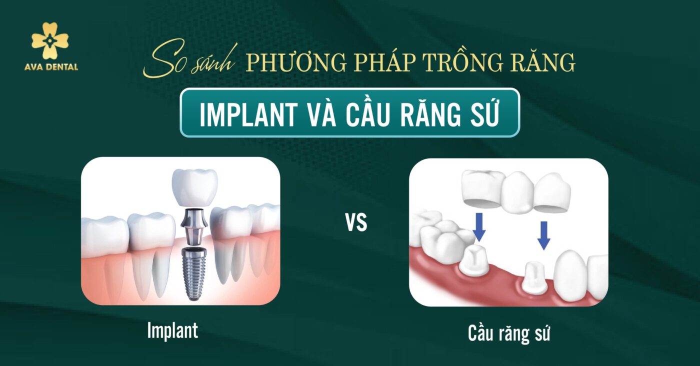 So sánh phương pháp Trồng răng Implant và Cầu răng sứ 5 7aaf38ae69f4bdaae4e5