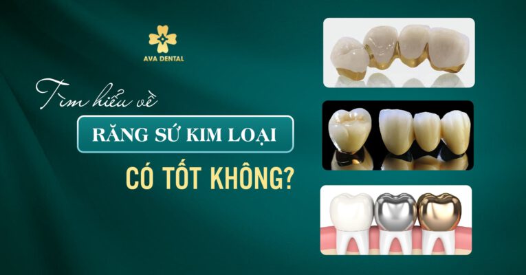 răng sứ kim loại