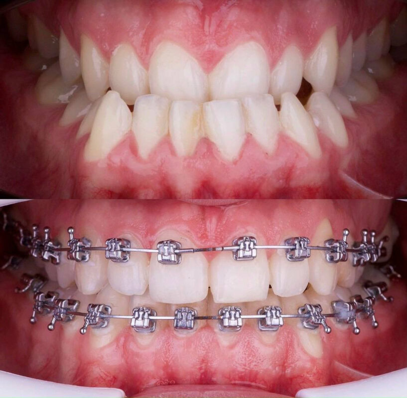 Niềng răng Invisalign - Phương pháp niềng răng hiện đại cho một nụ cười hoàn hảo 5 0f5a3a029aad4ef317bc