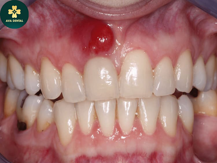 Chân răng có mủ - Nguyên nhân và giải pháp khắc phục hiệu quả 4 1qu