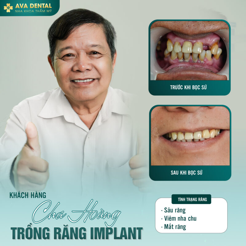 Bật Mí Thông Tin Hữu Ích Về Trồng Răng Implant 10 Trồng răng implant