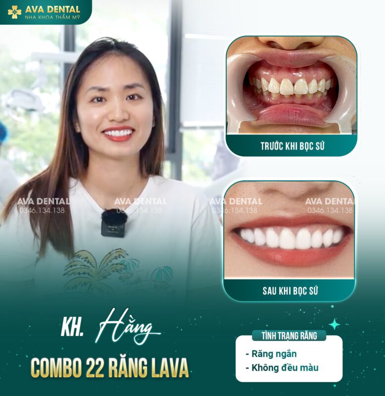So sánh Bọc răng sứ và Cầu răng sứ: Nên chọn phương pháp trồng răng nào? 5 378528615 686036640222343 2395039126944281710 n 1