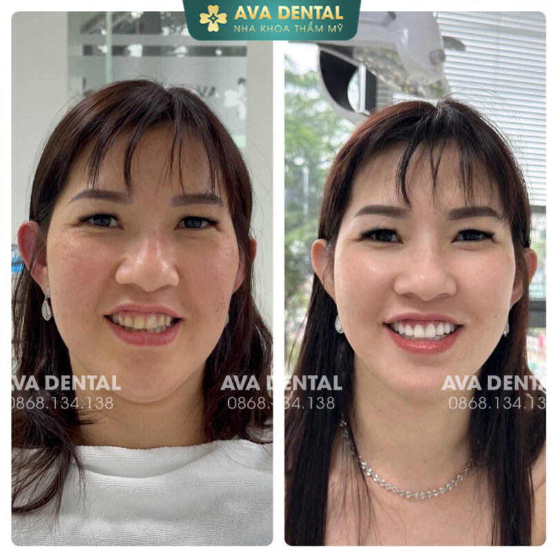 Hở chân răng là gì? Làm sao để khắc phục hở chân răng 5 387203396 704164808409526 6964440615942706500 n 1