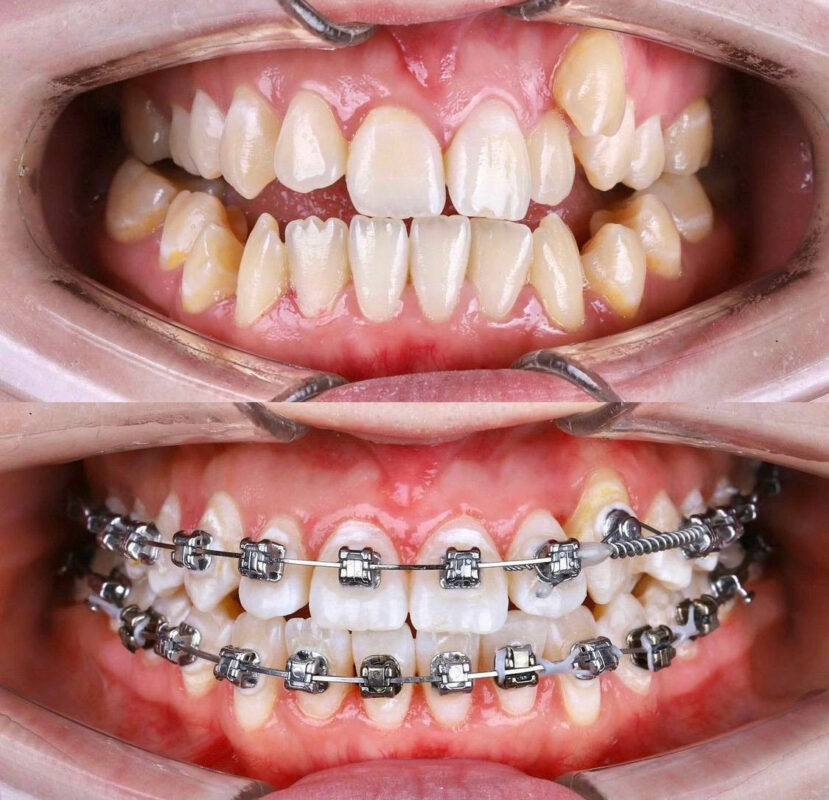 Tìm hiểu chi tiết về phương pháp niềng răng mắc cài kim loại 4 55ea4985e92a3d74643b 1