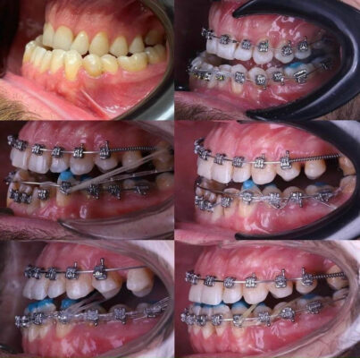 niềng răng mắc cài kim loại