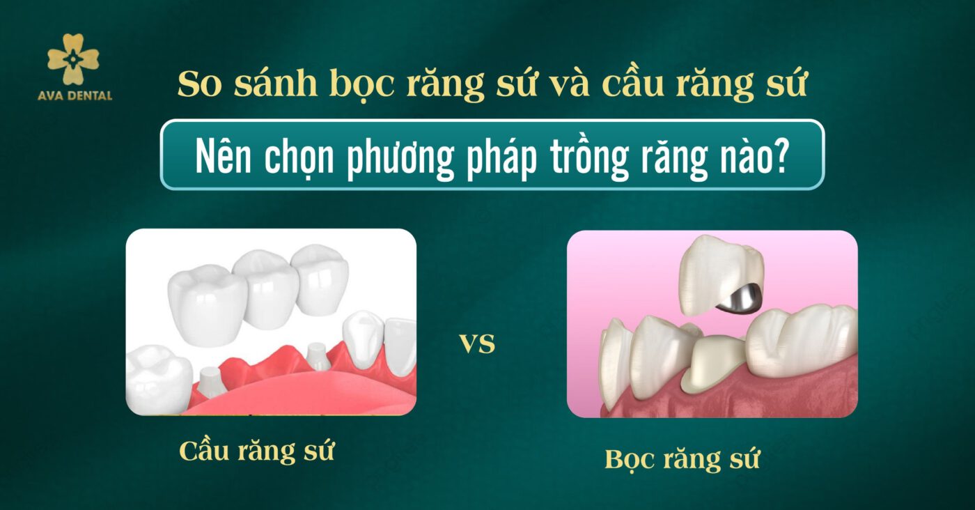 So sánh Bọc răng sứ và Cầu răng sứ: Nên chọn phương pháp trồng răng nào? 4 bọc răng sứ và cầu răng sứ