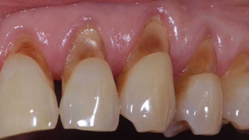 HIỂU ĐÚNG HIỂU ĐỦ VỀ DỊCH VỤ NHA KHOA TRÁM RĂNG 10 trám răng