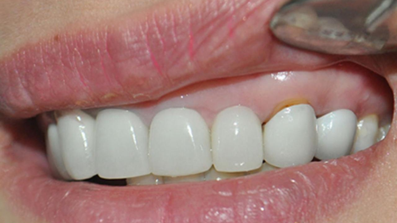 Dấu hiệu răng sứ bị hở và biện pháp khắc phục 5 nhan biet nhung dau hieu rang su bi ho nguyen nhan va cach khac phuc b59769472a
