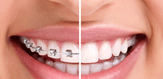 chi phí niềng răng mới nhất