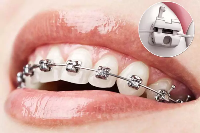 Mức chi phí niềng răng mới nhất năm 2023 5 nieng rang mac cai kim loai thuong va tu buoc 3