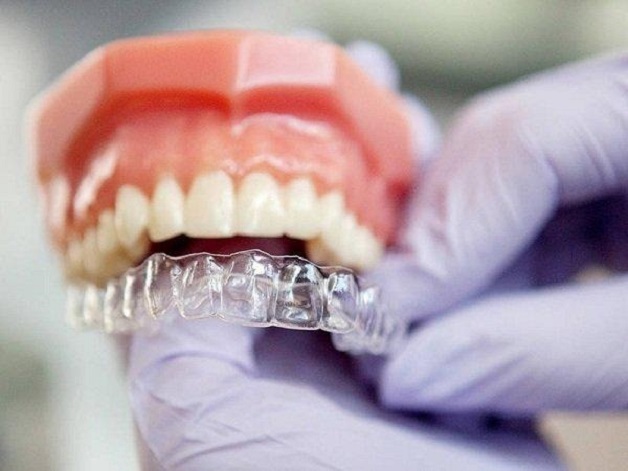 Niềng răng trong suốt giá bao nhiêu? Bảng giá chi tiết tại Avora Dental 5 nieng rang trong suot gia bao nhieu 4 1