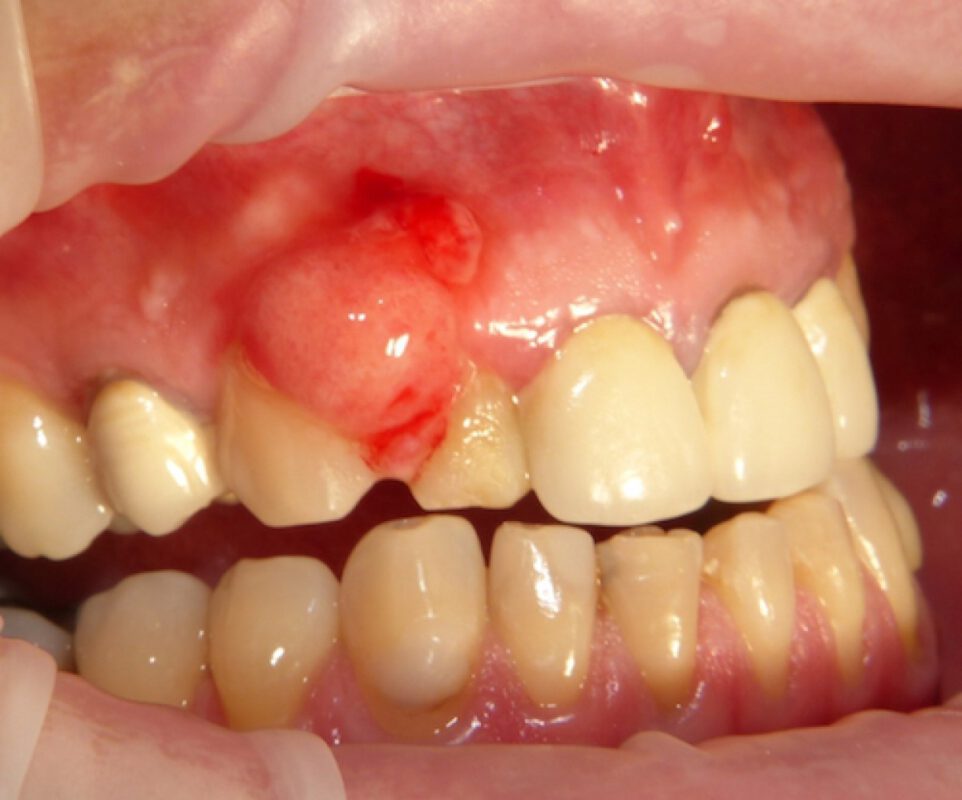 Chân răng có mủ - Nguyên nhân và giải pháp khắc phục hiệu quả 5 viem chan rang ham 21