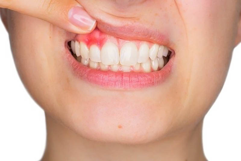 VIÊM NƯỚU RĂNG - NGUYÊN NHÂN VÀ CÁCH ĐIỀU TRỊ 9 viêm nướu răng
