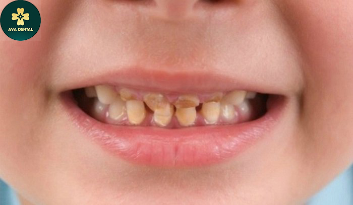 Mòn chân răng là bệnh gì? Dấu hiệu nhận biết và cách xử lý 4 mòn chân răng