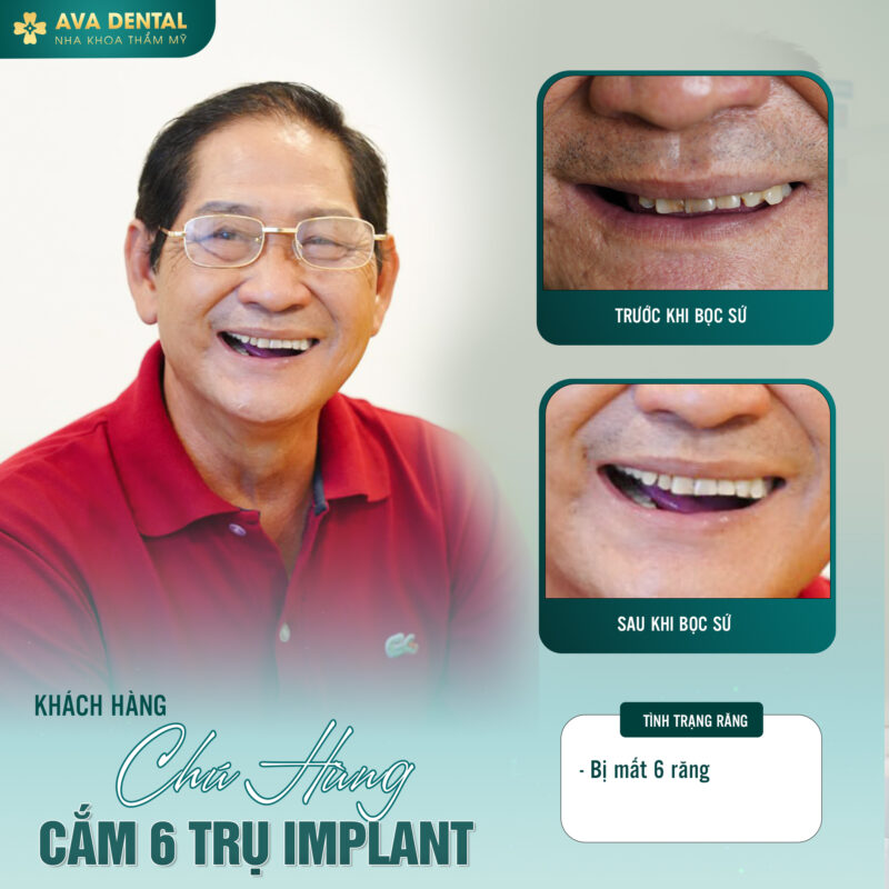 U xương chân răng là gì? Cách phòng tránh hiệu quả 6 377938202 686056266887047 4082853847487780222 n 2