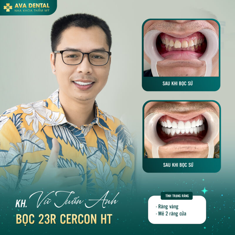 Răng sứ Zirconia và Vita: Đâu là lựa chọn phục hình răng hoàn hảo? 5 393695634 708016208024386 3840939396493471923 n