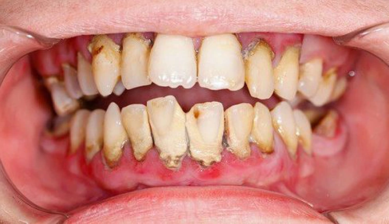 VIÊM NƯỚU RĂNG - NGUYÊN NHÂN VÀ CÁCH ĐIỀU TRỊ 10 btr 809843bba2