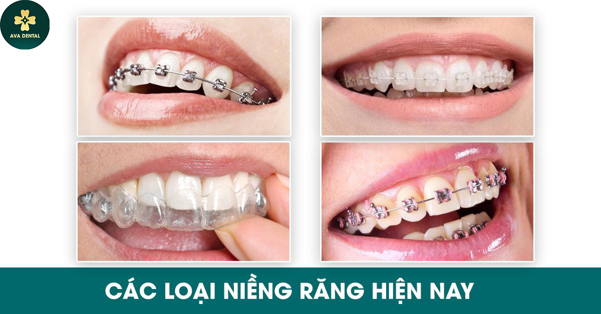 Nha Khoa Avora Dental - Một Trong Những Nha Khoa Niềng Răng Tốt Nhất Sài Gòn 11 Giá niềng răng tại Avora Dental