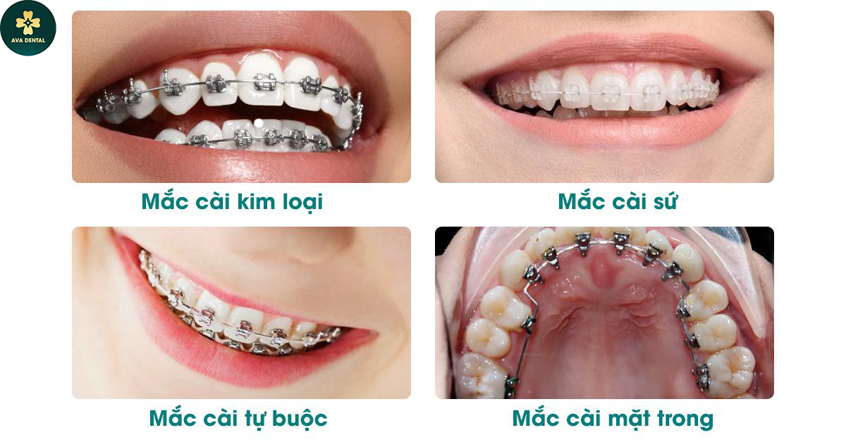 giá niềng răng
