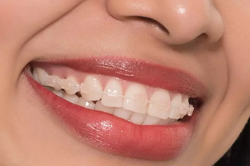Niềng răng mắc cài sứ: Ưu điểm, phân loại và lưu ý khi niềng 7 nieng rang mac cai su uu va nhuoc diem 4