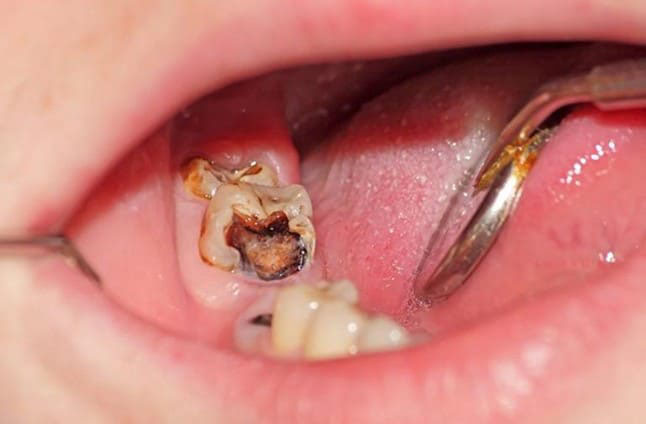 HIỂU ĐÚNG HIỂU ĐỦ VỀ DỊCH VỤ NHA KHOA TRÁM RĂNG 8 tuy rang la gi