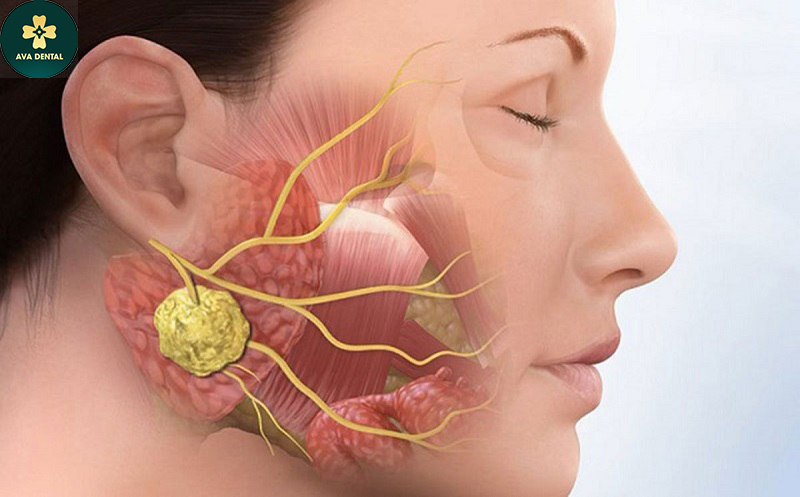 U xương chân răng là gì? Cách phòng tránh hiệu quả 4 u xương chân răng