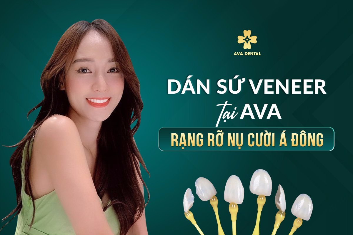 dán sứ veneer