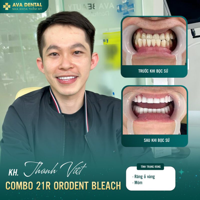 răng sứ orodent