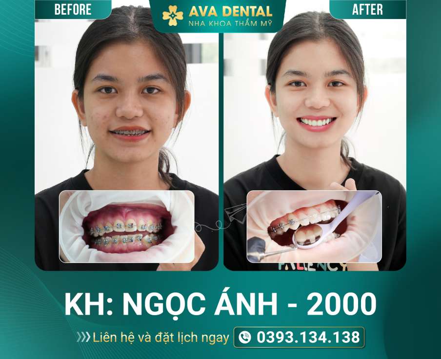 giá niềng răng