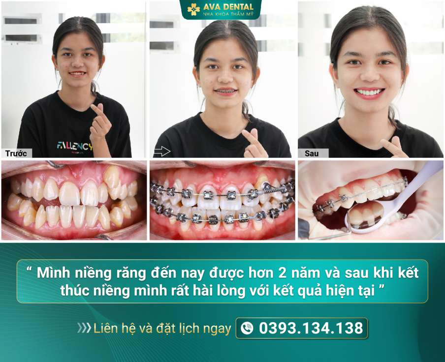  28 tuổi có niềng răng