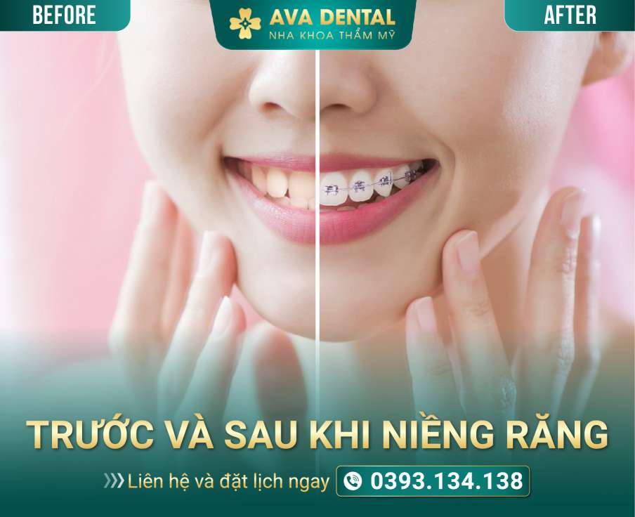 TRUOC VA SAU KHI NIENG RANG 01