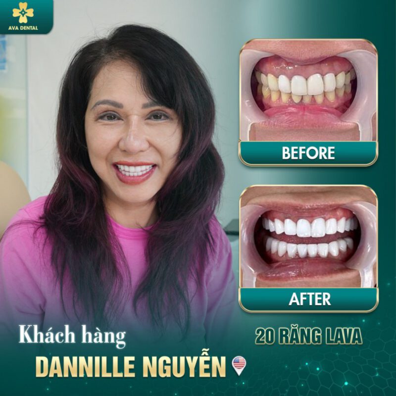 Răng Sứ Lava Esthetic