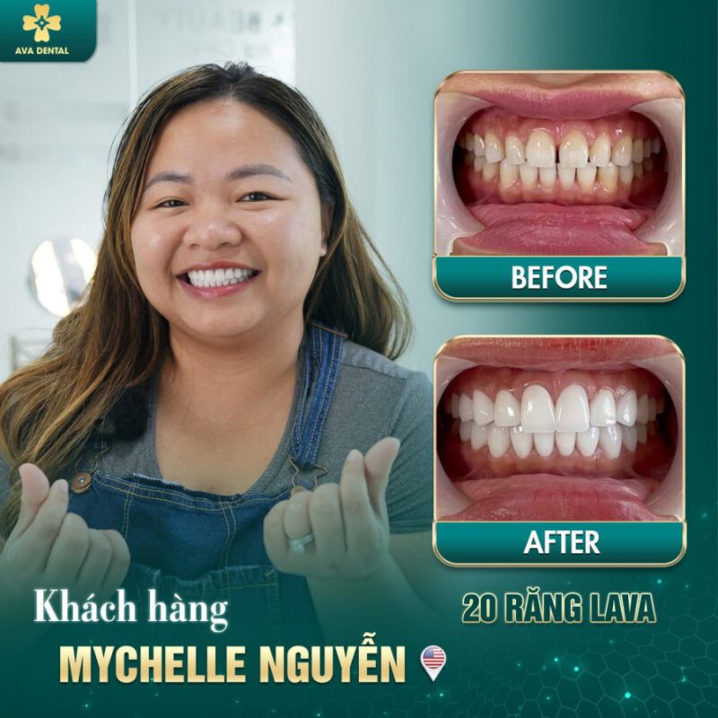 răng sứ thẩm mỹ