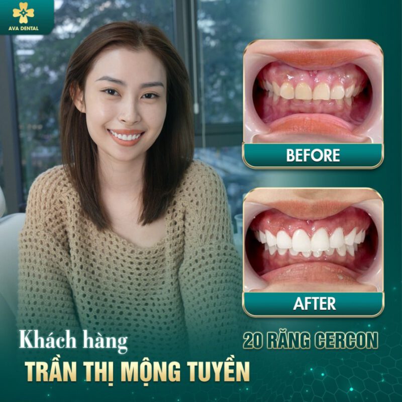 răng sứ thẩm mỹ
