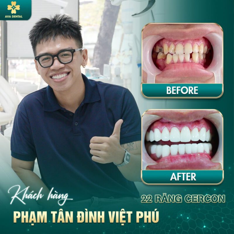 răng sứ thẩm mỹ