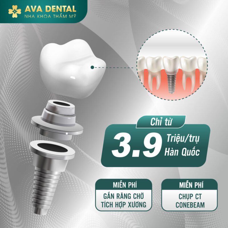 Bật Mí Thông Tin Hữu Ích Về Trồng Răng Implant 9 Trồng răng implant