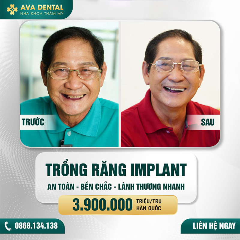trồng răng implant