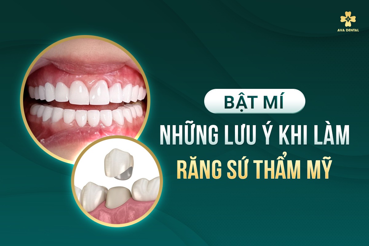Răng Sứ Thẩm Mỹ - Một Số Vấn Đề Cần Hiểu Rõ 7 răng sứ thẩm mỹ