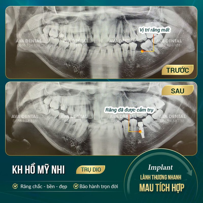 cắm implant có đau 